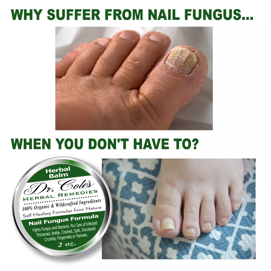 12 - Dr. Cole's Nail Fungus Balm - Image 5