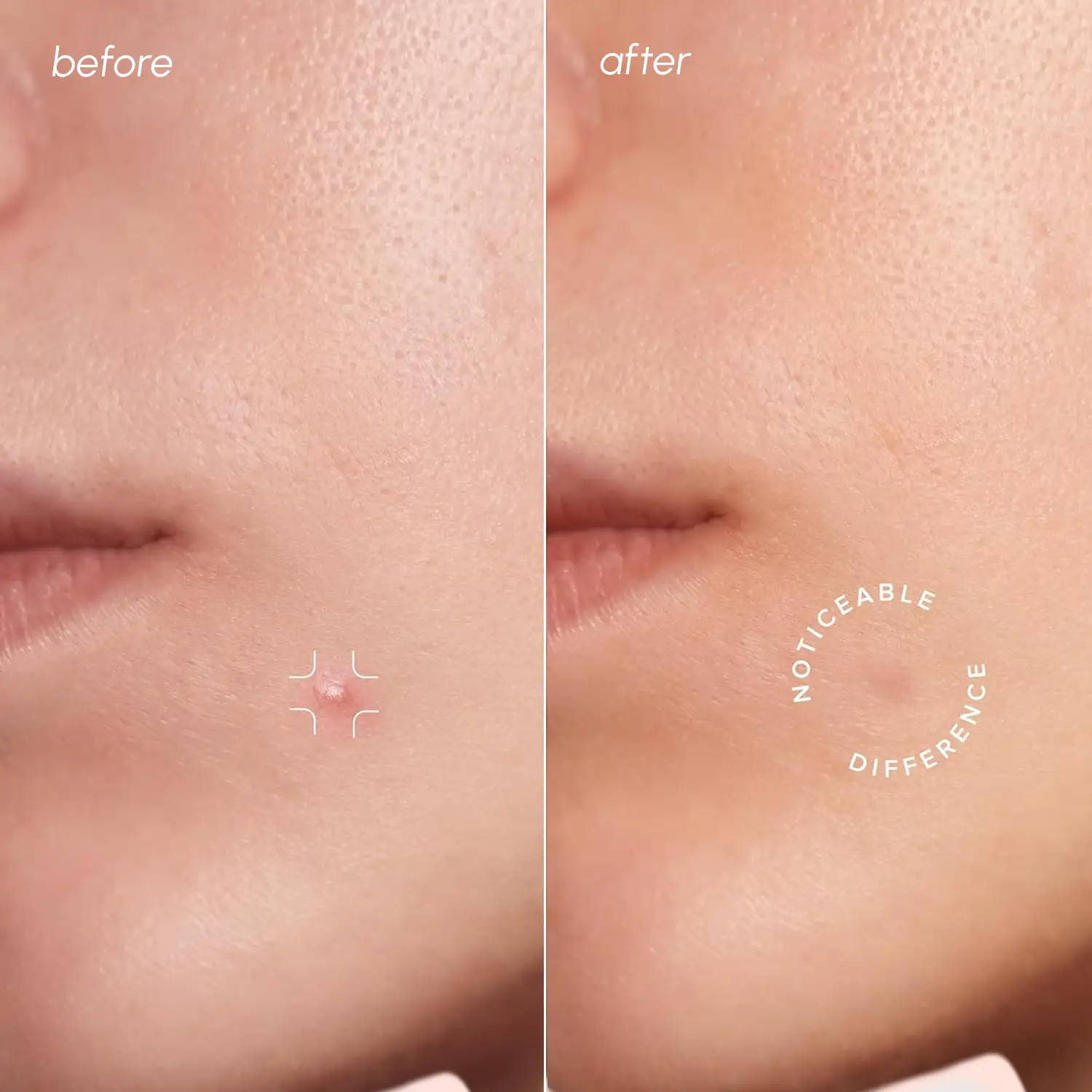 Invisible Pimple & Acne Patches - Image 2
