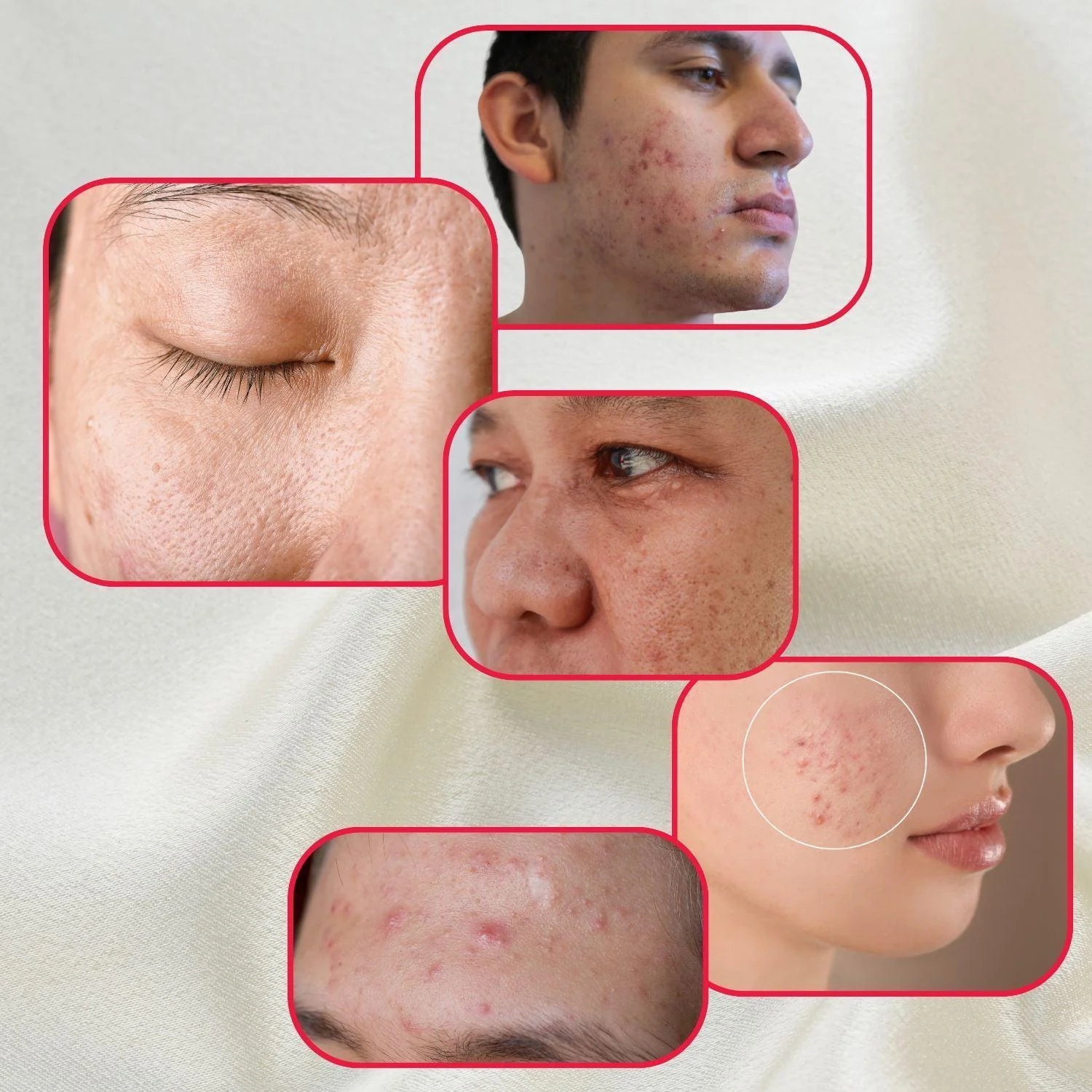 Perfect Trifecta Acne Peel - Image 3