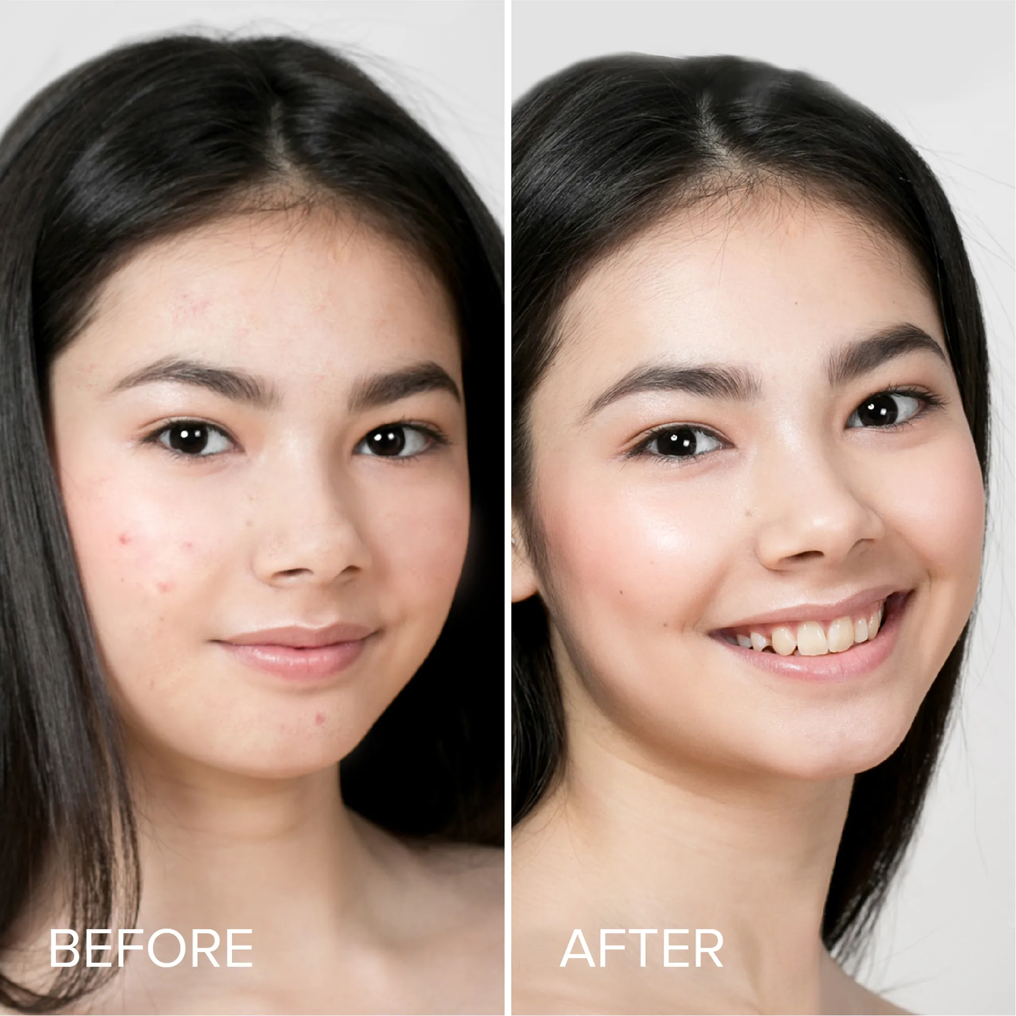 Pimple & Acne Patches - Image 3