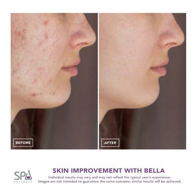 Spa Sciences BELLA 3-in-1 Diamond Tip Microdermabrasion System - New - Image 6
